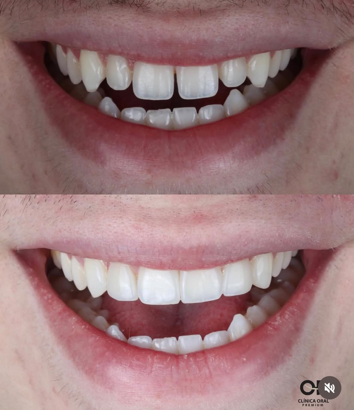 Antes e depois de estética dental — fechamento de diastema com facetas na OP, Natal/RN