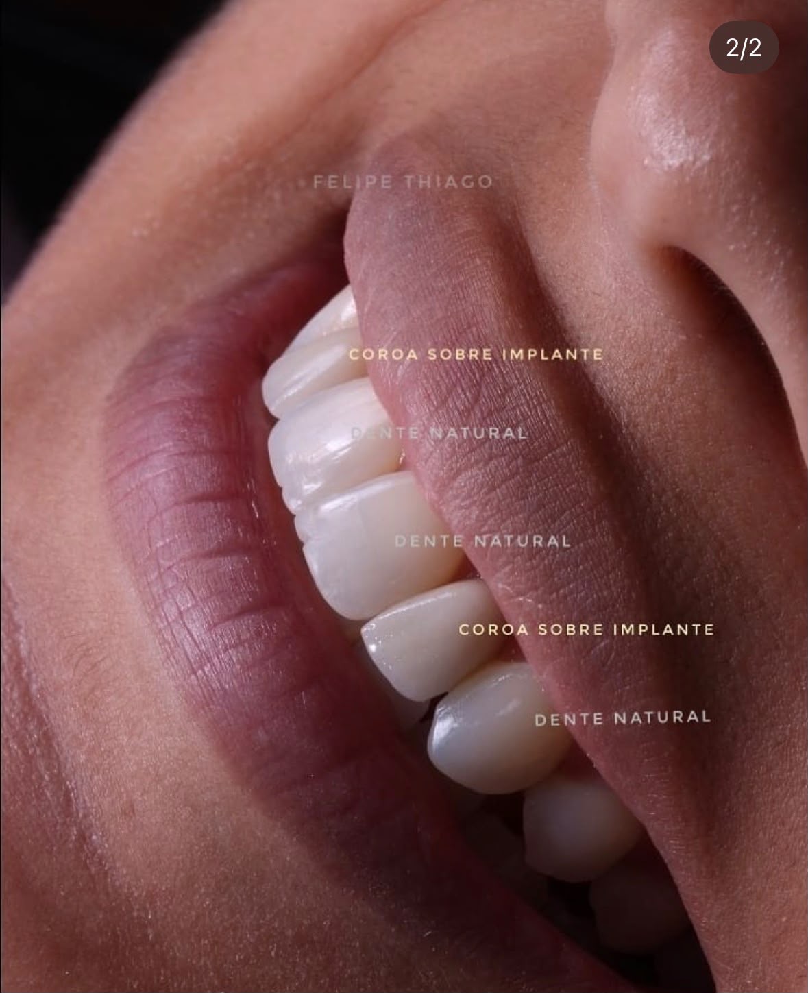 Coroa sobre implante com aspecto natural na OP, Natal/RN