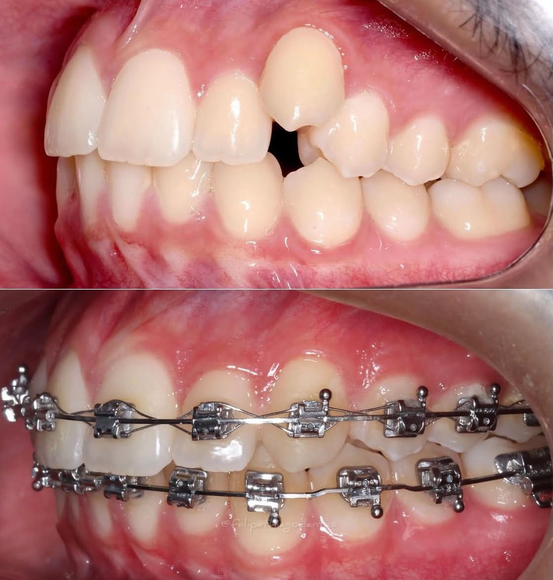 Antes e depois de tratamento com aparelho autoligado na OP, Natal/RN