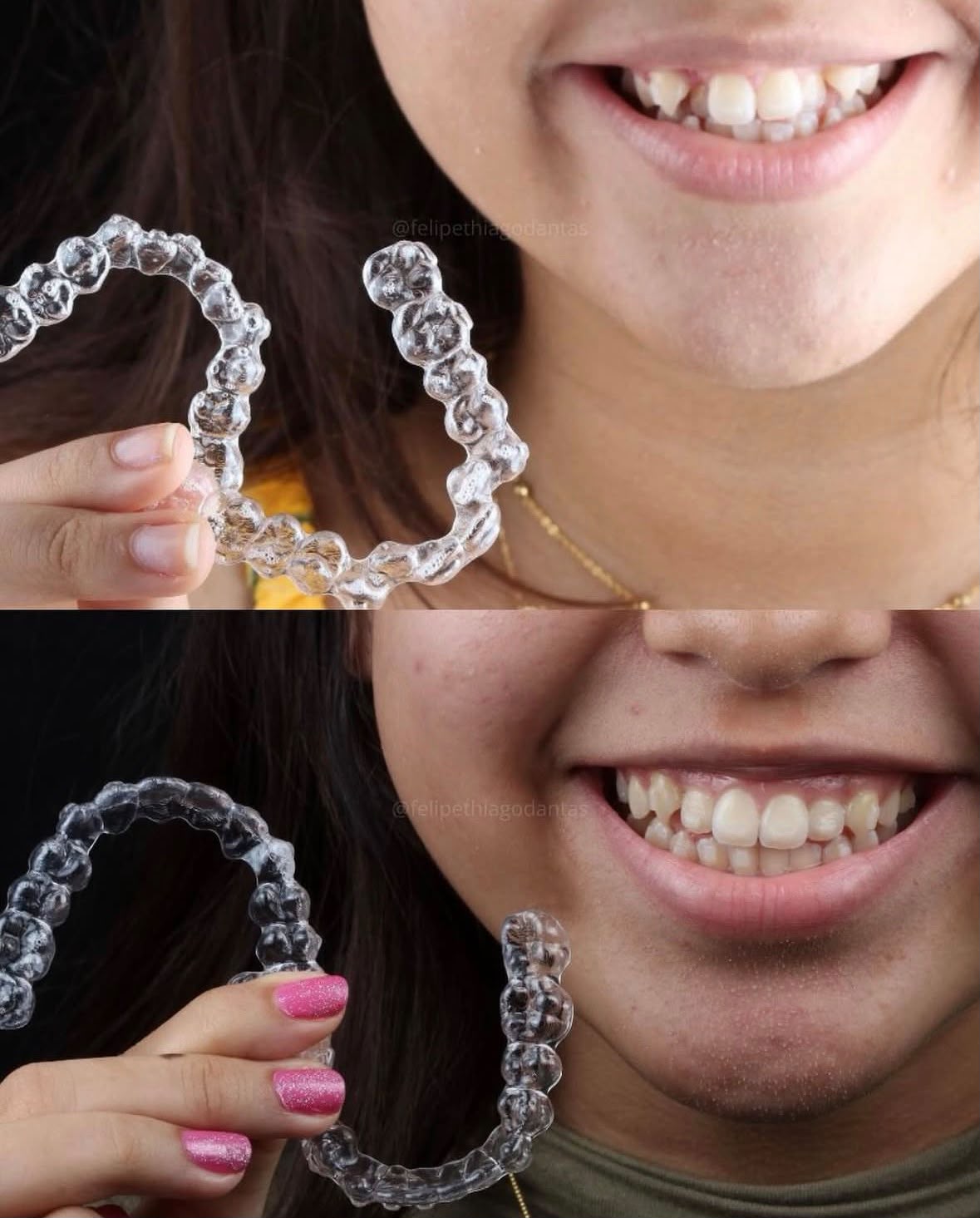 Antes e depois de tratamento com alinhadores invisíveis na OP, Natal/RN