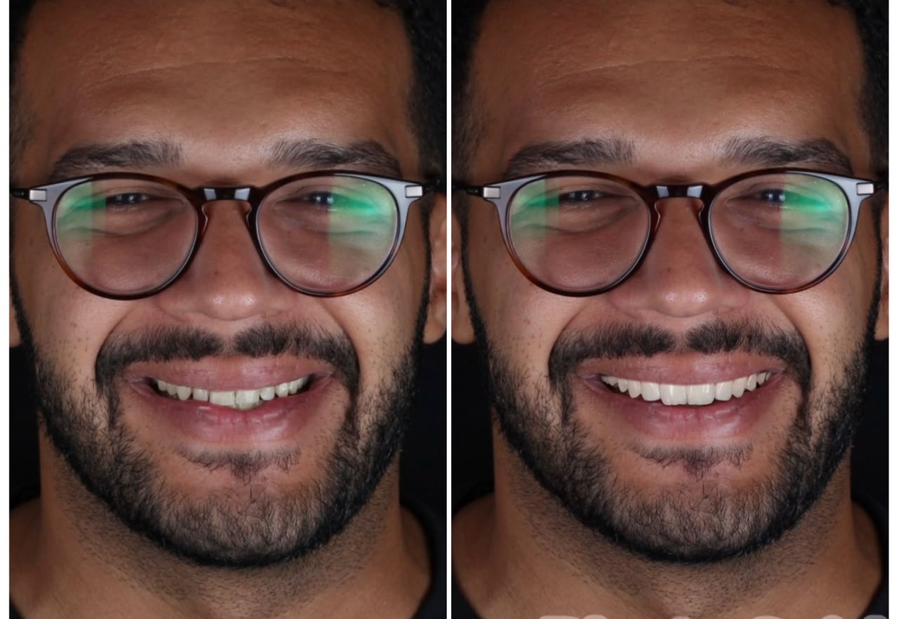 Antes e depois de estética dental na OP Odontologia Personalizada, Natal/RN